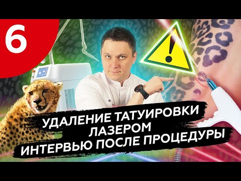 УДАЛЕНИЕ БОЛЬШОЙ ЛЕОПАРДОВОЙ ТАТУИРОВКИ #удалениетату #удалениетатуростов