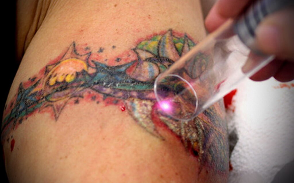 Татуировки и их удаление