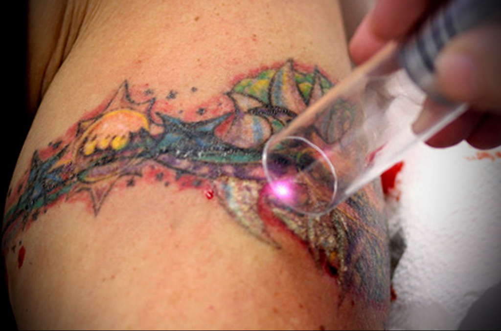 Татуировки и их удаление 2