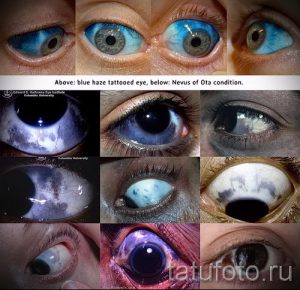 Коллаж фотографий, демонстрирующий процедуру татуировки склеры глаза, с различными оттенками синего и фиолетового. Предупреждение о рисках и сравнение с медицинским состоянием.