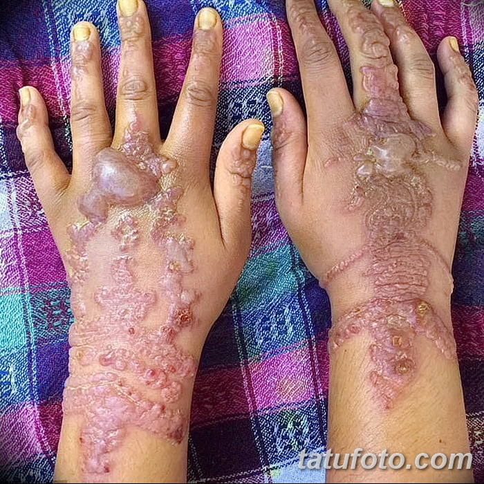 фото Последствия мехенди от 27.10.2017 №001 - Consequences of mehendi - tatufoto.com