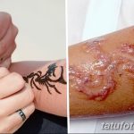 Фото неудачного мехенди, аллергическая реакция на хну, повреждение кожи, волдыри, воспаление, последствия некачественной хны.