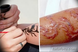 Фото неудачного мехенди, аллергическая реакция на хну, повреждение кожи, волдыри, воспаление, последствия некачественной хны.