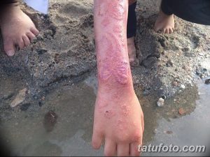 Фото аллергической реакции на хну, покраснение кожи, волдыри, раздражение, последствия некачественной хны.