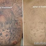 фото Выведение тату лазером от 14.01.2018 №001 - Laser tattoo removal - tatufoto.com