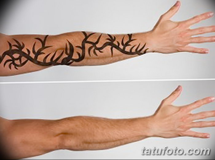 фото Выведение тату лазером от 14.01.2018 №003 - Laser tattoo removal - tatufoto.com