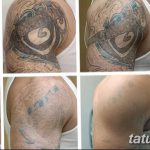 фото Выведение тату лазером от 14.01.2018 №003 - Laser tattoo removal - tatufoto.com 25234