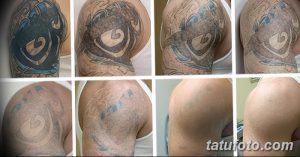 Фото тату до и после удаления: большая татуировка на плече с абстрактным узором, постепенно исчезающая после лазерных процедур.