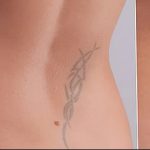 фото Выведение тату лазером от 14.01.2018 №005 - Laser tattoo removal - tatufoto.com