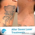 фото Выведение тату лазером от 14.01.2018 №006 - Laser tattoo removal - tatufoto.com
