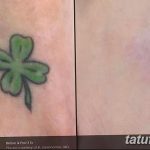 фото Выведение тату лазером от 14.01.2018 №008 - Laser tattoo removal - tatufoto.com