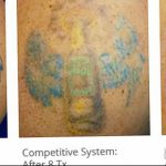 фото Выведение тату лазером от 14.01.2018 №010 - Laser tattoo removal - tatufoto.com