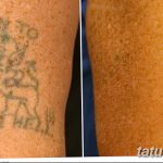 фото Выведение тату лазером от 14.01.2018 №011 - Laser tattoo removal - tatufoto.com
