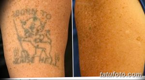 Фото тату до и после удаления: старая татуировка на плече, частично стертая лазером, демонстрирует прогресс процедуры.