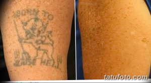 Фото тату до и после удаления: рука мужчины со старой, выцветшей татуировкой, демонстрирующее результаты лазерного удаления.