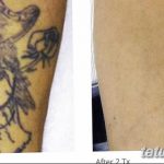 фото Выведение тату лазером от 14.01.2018 №017 - Laser tattoo removal - tatufoto.com