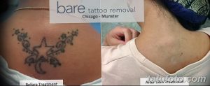 Фото тату до и после удаления: плечо женщины с татуировкой звезды и узоров, демонстрирующее результаты лазерного удаления.