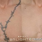 фото Выведение тату лазером от 14.01.2018 №019 - Laser tattoo removal - tatufoto.com