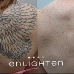 фото Выведение тату лазером от 14.01.2018 №020 - Laser tattoo removal - tatufoto.com