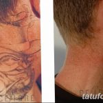 фото Выведение тату лазером от 14.01.2018 №022 - Laser tattoo removal - tatufoto.com