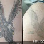 фото Выведение тату лазером от 14.01.2018 №024 - Laser tattoo removal - tatufoto.com