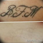 фото Выведение тату лазером от 14.01.2018 №025 - Laser tattoo removal - tatufoto.com