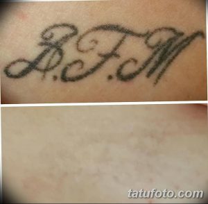 Фотография демонстрирует процесс удаления татуировки с надписью 'B.F.M.', расположенной на руке. Сравнение 'до' и 'после' показывает эффективность лазерного удаления.