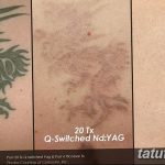 фото Выведение тату лазером от 14.01.2018 №026 - Laser tattoo removal - tatufoto.com