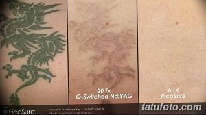 Фотография демонстрирует процесс удаления татуировки с изображением дракона, расположенной на спине. Сравнение 'до', 'после 20 сеансов Q-Switched Nd:YAG' и 'после 6 сеансов PicoSure'.
