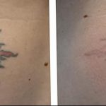 фото Выведение тату лазером от 14.01.2018 №027 - Laser tattoo removal - tatufoto.com