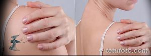 Фотография демонстрирует процесс удаления татуировки с изображением птицы, расположенной на лопатке. Сравнение 'до' и 'после' показывает эффективность лазерного удаления.
