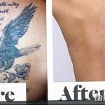 фото Выведение тату лазером от 14.01.2018 №031 - Laser tattoo removal - tatufoto.com