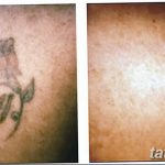 фото Выведение тату лазером от 14.01.2018 №032 - Laser tattoo removal - tatufoto.com