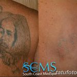 фото Выведение тату лазером от 14.01.2018 №033 - Laser tattoo removal - tatufoto.com