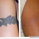 фото Выведение тату лазером от 14.01.2018 №034 - Laser tattoo removal - tatufoto.com