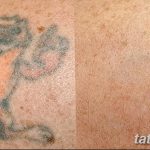 фото Выведение тату лазером от 14.01.2018 №035 - Laser tattoo removal - tatufoto.com