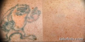 Фотография демонстрирует процесс удаления татуировки с изображением лица с плеча с помощью лазера. Сравнение до и после процедуры.