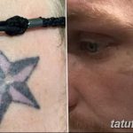 фото Выведение тату лазером от 14.01.2018 №036 - Laser tattoo removal - tatufoto.com