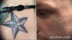Фотография демонстрирует процесс удаления татуировки в виде звезды с руки с помощью лазера. Сравнение до и после процедуры.