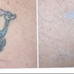 фото Выведение тату лазером от 14.01.2018 №037 - Laser tattoo removal - tatufoto.com