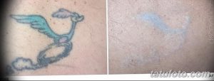 Фотография демонстрирует процесс удаления татуировки с изображением мультяшного персонажа (Птица-дорожник) с помощью лазера. Сравнение до и после процедуры.