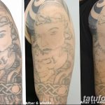 фото Выведение тату лазером от 14.01.2018 №038 - Laser tattoo removal - tatufoto.com