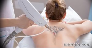 Фотография процесса лазерного удаления татуировки с изображением цветка лотоса на спине женщины. Виден аппарат и работа мастера.
