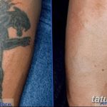 фото Выведение тату лазером от 14.01.2018 №040 - Laser tattoo removal - tatufoto.com