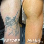 фото Выведение тату лазером от 14.01.2018 №043 - Laser tattoo removal - tatufoto.com