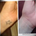 фото Выведение тату лазером от 14.01.2018 №044 - Laser tattoo removal - tatufoto.com
