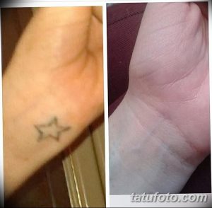 Фото до и после удаления маленькой татуировки звездочки на запястье. Видно значительное осветление и исчезновение рисунка.
