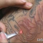 фото Выведение тату лазером от 14.01.2018 №045 - Laser tattoo removal - tatufoto.com