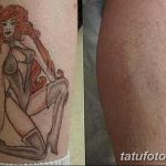 фото Выведение тату лазером от 14.01.2018 №046 - Laser tattoo removal - tatufoto.com