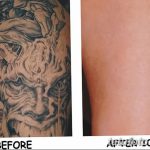фото Выведение тату лазером от 14.01.2018 №047 - Laser tattoo removal - tatufoto.com